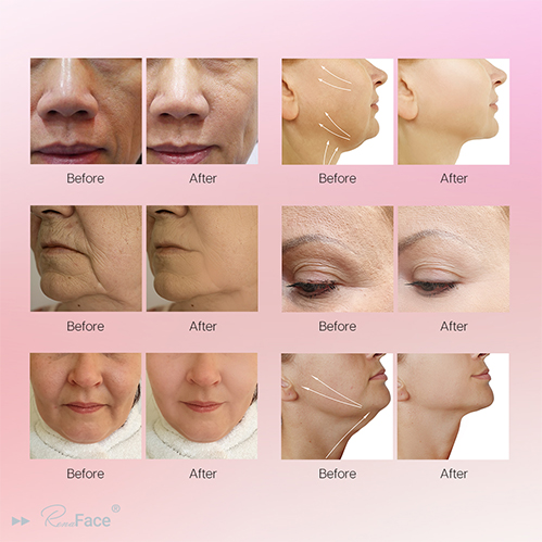 High-Intensity Electromagnetic Stimulation Synchronized RF Renaface Facial Lifting System