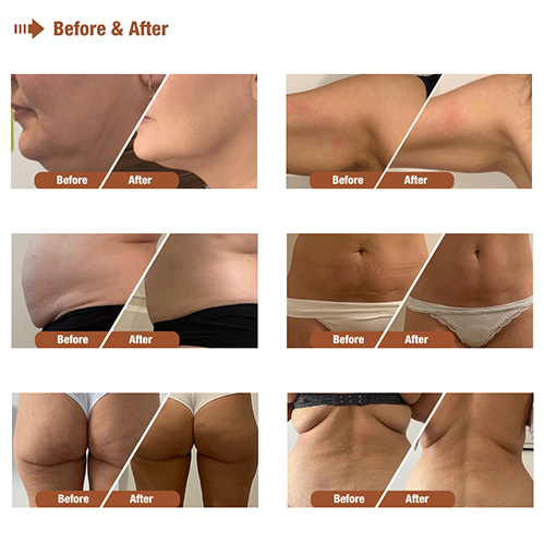 Professional 40K Ultrasound Cavitation & Multi-Polar RF Slimming System